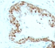 IHC: Formalin-fixed, paraffin-embedded human prostate carcinoma stained with p57 antibody (clone KIP2/880).
