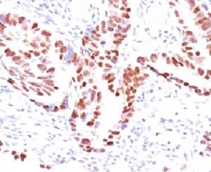 IHC: Formalin-fixed, paraffin-embedded human colon carcinoma stained with p57 antibody (clone KIP2/880).~
