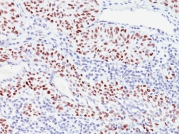 IHC analysis of formalin-fixed, paraffin-embedded human bladder carcinoma stained with p57 antibody (57P06).~