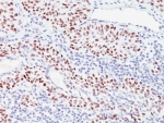 IHC analysis of formalin-fixed, paraffin-embedded human bladder carcinoma stained with p57 antibody (57P06).