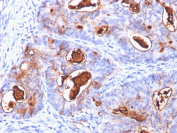 CEA Antibody Colon Carcinoma IHC. Immunohistochemistry staining of formalin-fixed, paraffin-embedded human colon carcinoma with CEA antibody (clone C66/1260).