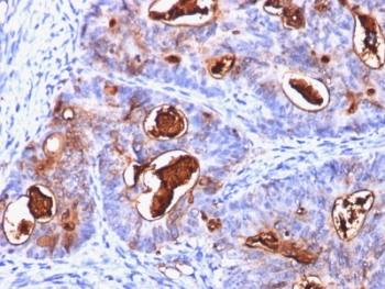 IHC: Formalin-fixed, paraffin-embedded human colon carcinoma stained with CEA antibody (C66/1260).~