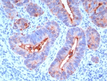 IHC: Formalin-fixed, paraffin-embedded human colon carcinoma stained with CEA antibody (C66/195).~