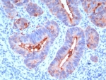 IHC: Formalin-fixed, paraffin-embedded human colon carcinoma stained with CEA antibody (C66/195).