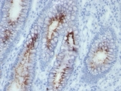 IHC: Formalin-fixed, paraffin-embedded human colon carcinoma stained with anti-CEA antibody (SPM506)
