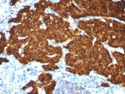 IHC: Formalin-fixed, paraffin-embedded pheochromocytoma stained with Chromogranin A antibody cocktail(CGA/413 + CHGA/777 + CHGA/798)