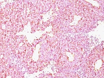 IHC: Formalin-paraffin human SC lung carcinoma stained with Chromogranin A antibody (CHGA/798)