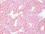 IHC: Formalin-paraffin human SC lung carcinoma stained with Chromogranin A antibody (CHGA/798)