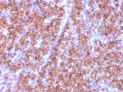 IHC: Formalin-fixed, paraffin-embedded human parathyroid stained with Chromogranin A antibody (CGA/413)