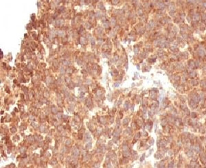 IHC: Formalin-fixed, paraffin-embedded human melanoma stained with TOP1MT antibody (clone TOP1MT/488).~