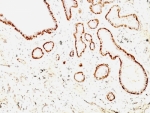 IHC: Formalin-fixed, paraffin-embedded human breast carcinoma stained with Calponin antibody (CNN1/832 + CALP).
