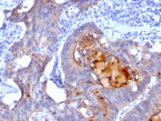 Secretory Component Glycoprotein Antibody IHC. Immunohistochemistry using formalin-fixed, paraffin-embedded human colon carcinoma stained with recombinant Secretory Component Glycoprotein antibody (rECM1/792).