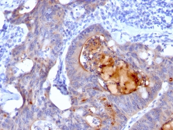 IHC: Formalin-fixed, paraffin-embedded human colon carcinoma stained with recombinant Secretory Component Glycoprotein antibody (rECM1/792).~