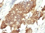 IHC: Formalin-fixed, paraffin-embedded human gastric carcinoma stained with Estrogen Receptor beta antibody (ESR2/686).