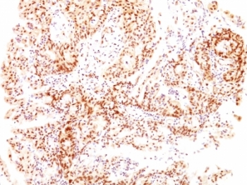 IHC: Formalin-fixed, paraffin-embedded human ovarian carcinoma stained with Estrogen Receptor beta antibody (ESR2/686).