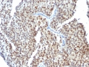 IHC: Formalin-fixed, paraffin-embedded human bladder carcinoma stained with Estrogen Receptor beta antibody (ESR2/686).