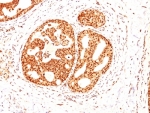 IHC: Formalin-fixed, paraffin-embedded human breast carcinoma stained with Estrogen Receptor beta antibody (ESR2/686).