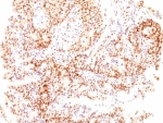 Formalin-fixed, paraffin-embedded human ovarian carcinoma stained with Estrogen Receptor beta antibody (ESR2/686).IHC: 