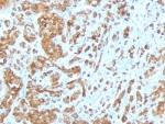 IHC: Formalin-fixed, paraffin-embedded human melanoma stained with Melan-A antibody (MLANA/788).