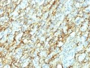 IHC: Formalin-fixed, paraffin-embedded human renal cell carcinoma stained with Fibronectin antibody (clone 568).
