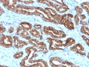 IHC staining of FFPE human prostate carcinoma with p504S antibody (clone 13H4). HIER: boil tissue sections in pH 9 10mM Tris with 1mM EDTA for 20 min and allow to cool before testing.
