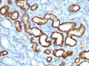 IHC staining of FFPE human renal cell carcinoma with p504S antibody (clone 13H4). HIER: boil tissue sections in pH 9 10mM Tris with 1mM EDTA for 20 min and allow to cool before testing.