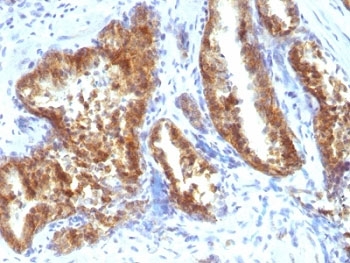 Formalin-fixed, paraffin-embedded human prostate carcinoma stained with AMACR antibody.~