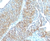 IHC: Formalin-fixed, paraffin-embedded human esophageal carcinoma stained with TRIM29 antibody (clone TRIM29/1041).