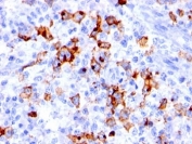 IHC: Formalin-fixed, paraffin-embedded human Hodgkin's lymphoma stained with CD15 antibody (BRA-4F1).
