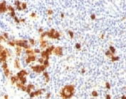 IHC: Formalin-fixed, paraffin-embedded human Hodgkin's lymphoma stained with SSEA-1 antibody (FUT4/815 + BRA-4F1).