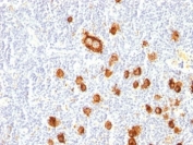 IHC: Formalin-fixed, paraffin-embedded human Hodgkin's lymphoma stained with CD15 antibody (clone FUT4/815).