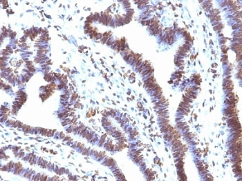 IHC: Formalin-fixed, paraffin-embedded human ovarian carcinoma stained with EMI1 antibody (clone EMI1/1176).~