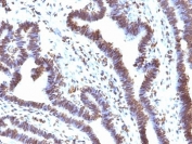 IHC: Formalin-fixed, paraffin-embedded human ovarian carcinoma stained with EMI1 antibody (clone EMI1/1176).