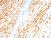 IHC: Formalin-fixed, paraffin-embedded human Schwanoma stained with GFAP antibody (ASTRO/789).