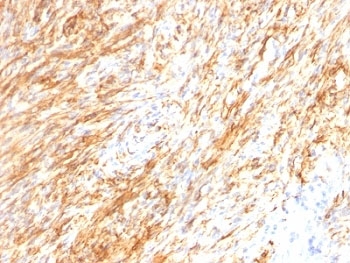 IHC: Formalin-fixed, paraffin-embedded human Schwanoma stained with GFAP antibody cocktail (GA-5 + ASTRO/789).~