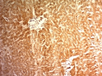 IHC: Formalin-fixed, paraffin-embedded human hepatocellular carcinoma stained with Glypican-3 antibody (clone 1G12).~