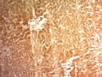 IHC: Formalin-fixed, paraffin-embedded human hepatocellular carcinoma stained with Glypican-3 antibody (clone 1G12).