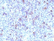 IHC: Formalin-fixed, paraffin-embedded human melanoma stained with Glypican-3 antibody (clone SPM595).