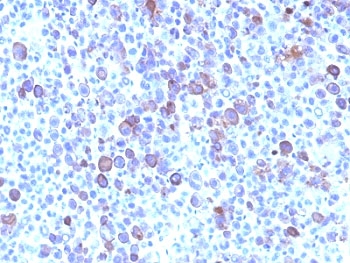 IHC: Formalin-fixed, paraffin-embedded human melanoma stained with Glypican-3 antibody (clone SPM595).