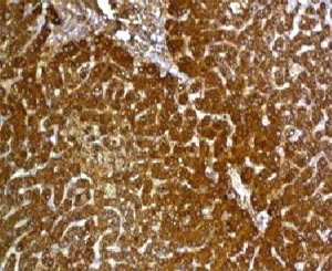 IHC: Formalin-fixed, paraffin-embedded human hepatocellular carcinoma stained with Glypican-3 antibody (GPC3/863)~