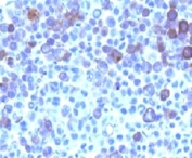 IHC: Formalin-fixed, paraffin-embedded human melanoma stained with Glypican-3 antibody (GPC3/863)