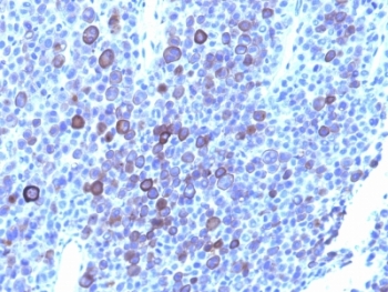 IHC: Formalin-fixed, paraffin-embedded human melanoma stained with Glypican-3 antibody (1G12 + GPC3/863)~