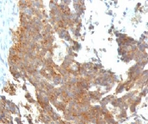 IHC: Formalin-fixed, paraffin-embedded human ovarian carcinoma stained with GnRH Receptor antibody (clone GNRHR/768).~