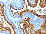 IHC: Formalin-fixed, paraffin-embedded human colon carcinoma stained with  Blood Group B antibody (HEB-20).