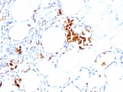IHC-P: Formalin-fixed, paraffin-embedded human angiosarcoma stained with Glycophorin A antibody (clone GYPA/280).
