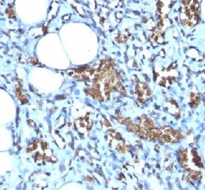 IHC-P: Formalin-fixed, paraffin-embedded human angiosarcoma stained with Glycophorin A antibody (clone GYPA/280).~