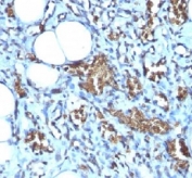 IHC-P: Formalin-fixed, paraffin-embedded human angiosarcoma stained with Glycophorin A antibody (clone GYPA/280).