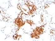 IHC testing of FFPE human angiosarcoma stained with anti-Glycophorin A antibody (clone SPM599). Required HIER: boil tissue sections in pH 9 10mM Tris with 1mM EDTA for 10-20 min.