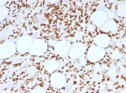 IHC: FFPE human angiosarcoma tested with Histone antibody (AE-4)