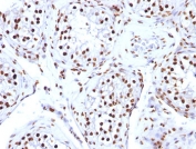 IHC: FFPE human testicular carcinoma tested with Histone antibody (AE-4)